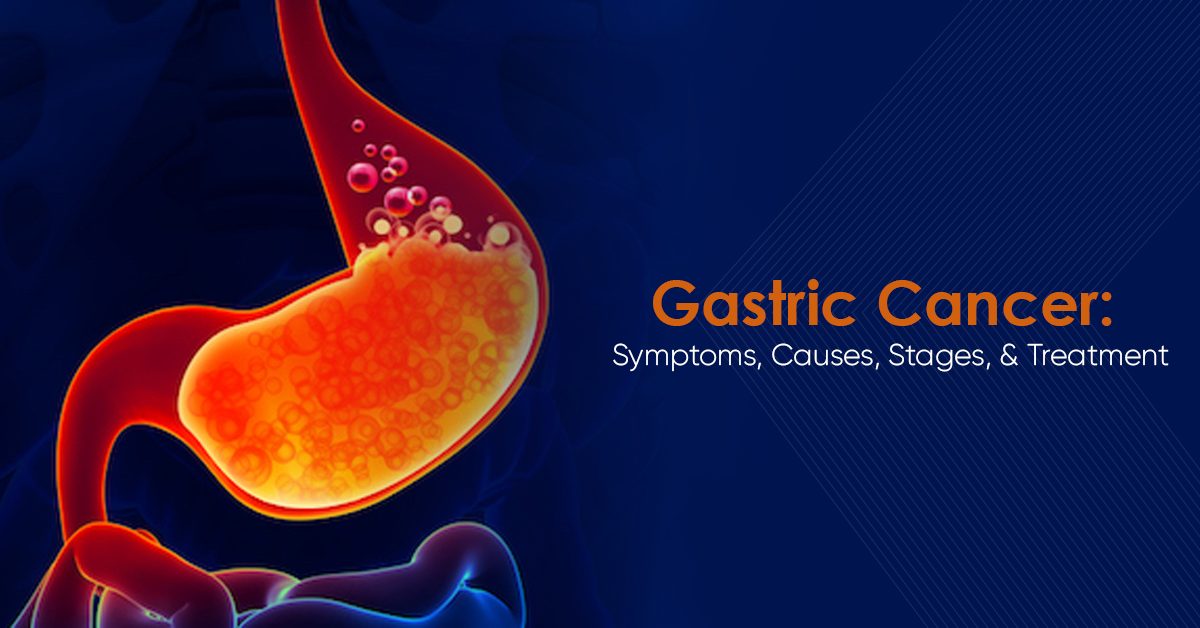 Gastric Cancer: Symptoms, Causes, Stages, Treatment