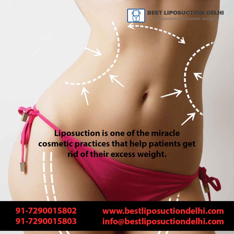 Is Full Body Liposuction Cosmetic Procedure Beneficial for Men?