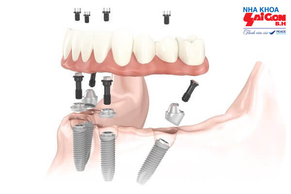 Trồng răng implant giải pháp phục hồi răng hoàn hảo - Công ty TNHH Nha Khoa SÀI GÒN B.H
