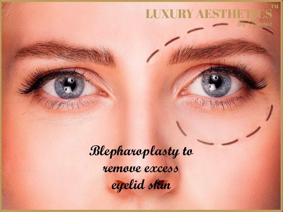 Blepharoplasty to Remove Excess Eyelid Skin