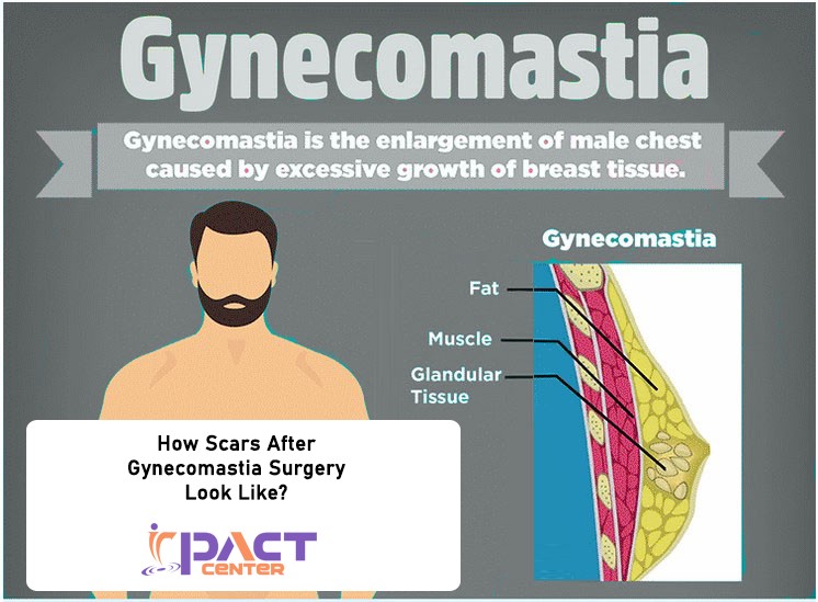 How Scars After Gynecomastia Surgery Look Like? | by IPACT CENTER | May, 2022 | Medium